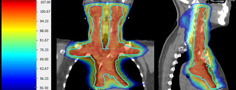 Linfoma