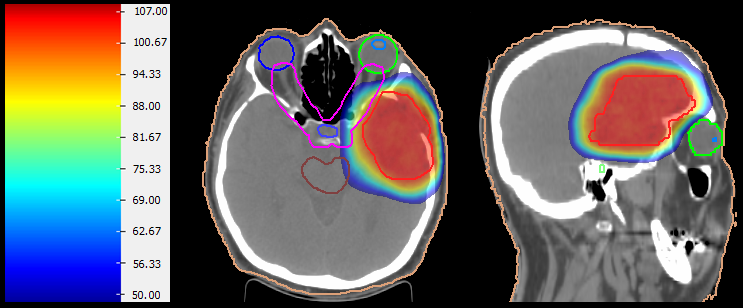 Meningioma